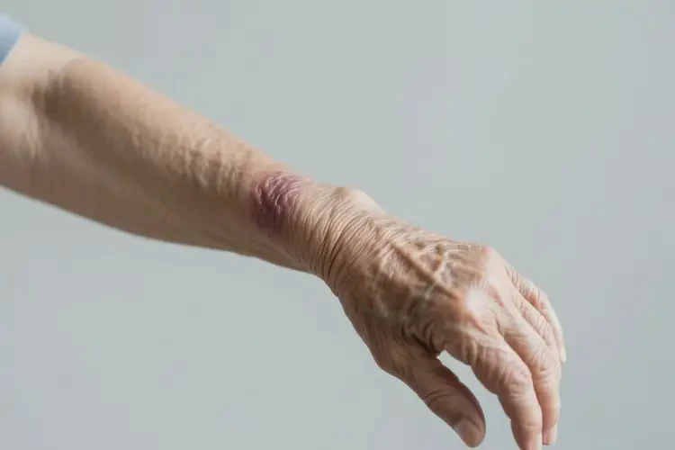 老年人手臂上偶爾起濕疹能不能徹底自愈(圖3)