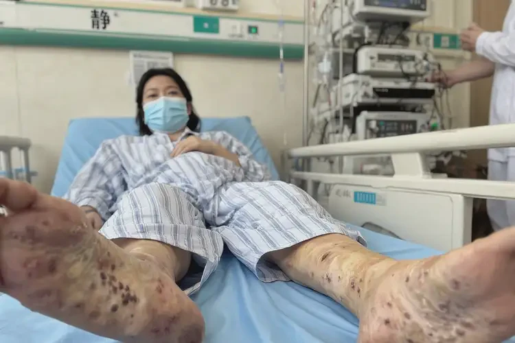 產(chǎn)婦大腿上有濕疹可不可以徹底自愈(圖3)