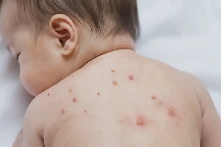 寶寶脖子上經(jīng)常長濕疹不管它會自己自愈嗎(圖4)