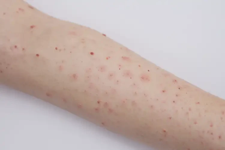 中學(xué)生手臂上起濕疹不管它會自己好嗎(圖4)
