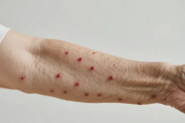 老年人手臂上偶爾長濕疹不管它會自己痊愈嗎(圖1)