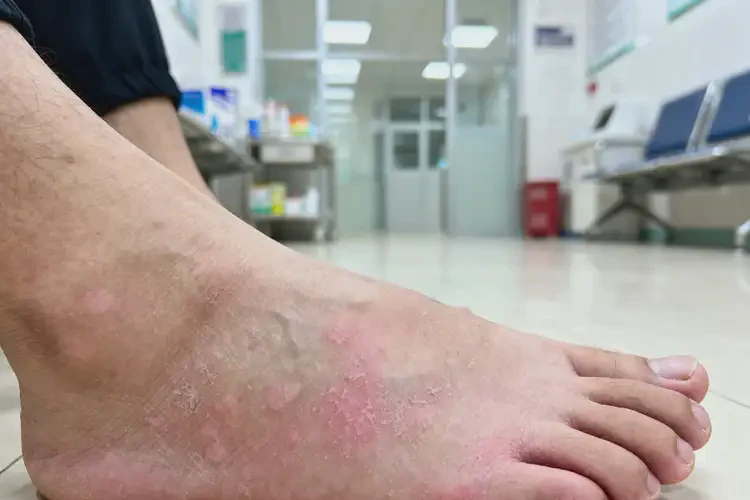 青年人脚上长湿疹可以彻底自愈吗(图2)