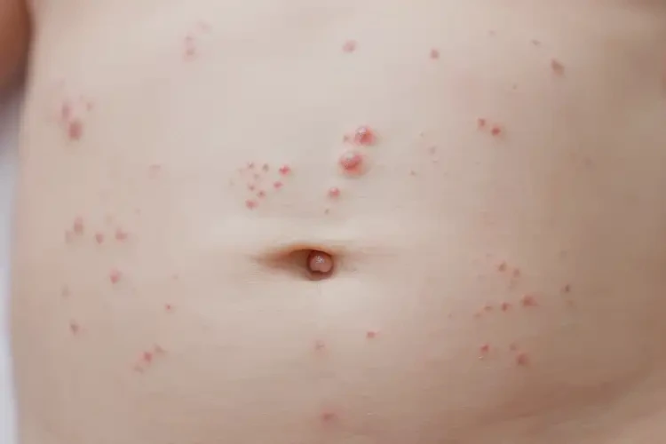 新生兒肚子上長(zhǎng)濕疹可以徹底自愈嗎(圖4)