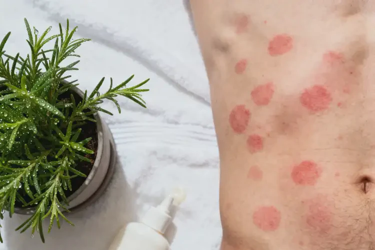 男生肚子出濕疹可不可以徹底自愈(圖2)