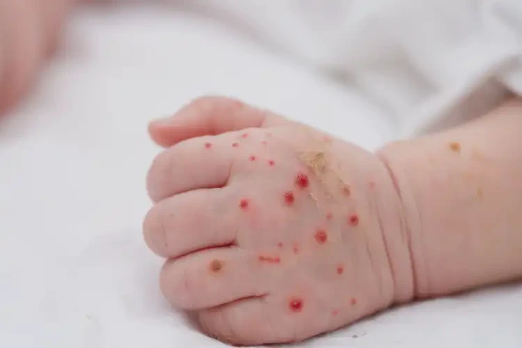 新生兒手上經(jīng)常長(zhǎng)濕疹可以徹底自愈嗎(圖3)