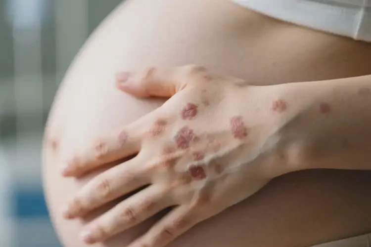 孕妇全身偶尔起湿疹不管它会自己自愈吗(图4)