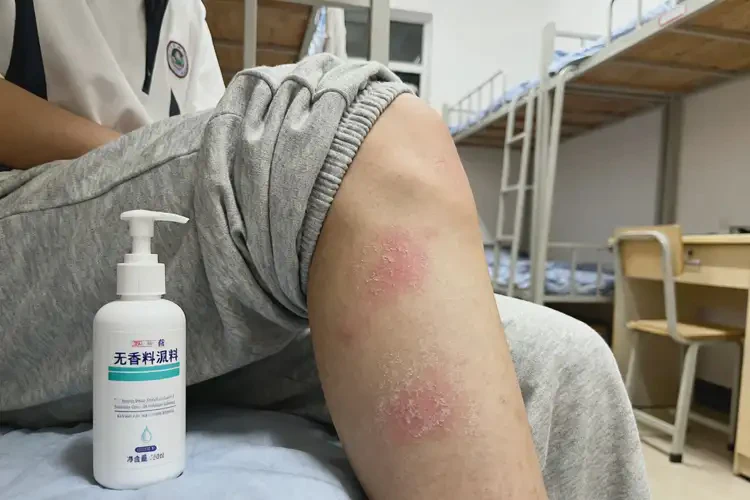 大学生大腿上有湿疹不管它会自己自愈吗(图4)