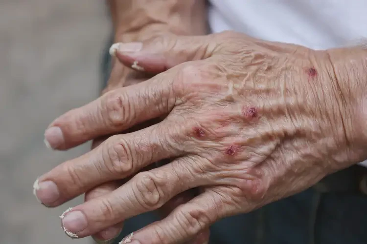 高齡老人手上有濕疹不管它會自己自愈嗎(圖4)