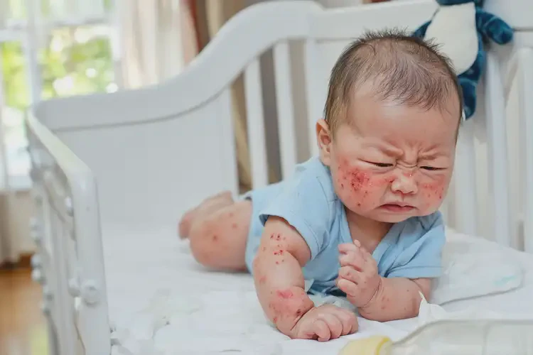 嬰兒全身有濕疹不管它會自己自愈嗎(圖2)