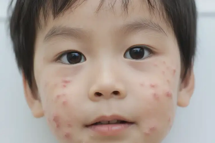 兒童面部偶爾長(zhǎng)濕疹能靠自己自愈嗎(圖4)