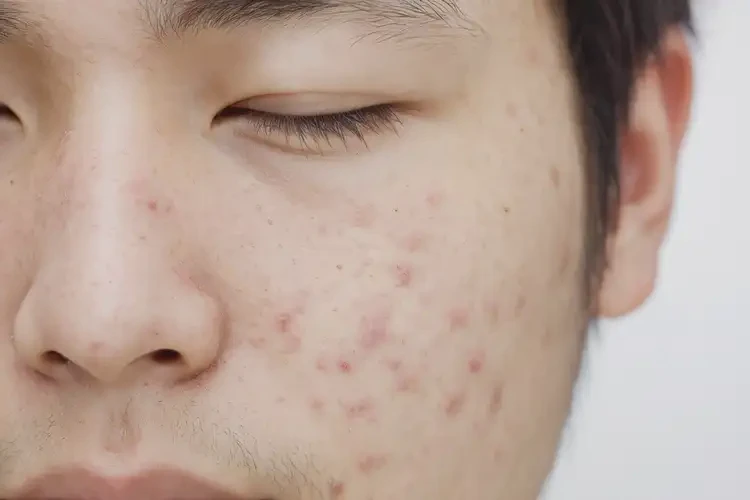 青年人面部出現(xiàn)濕疹能徹底自愈嗎(圖4)