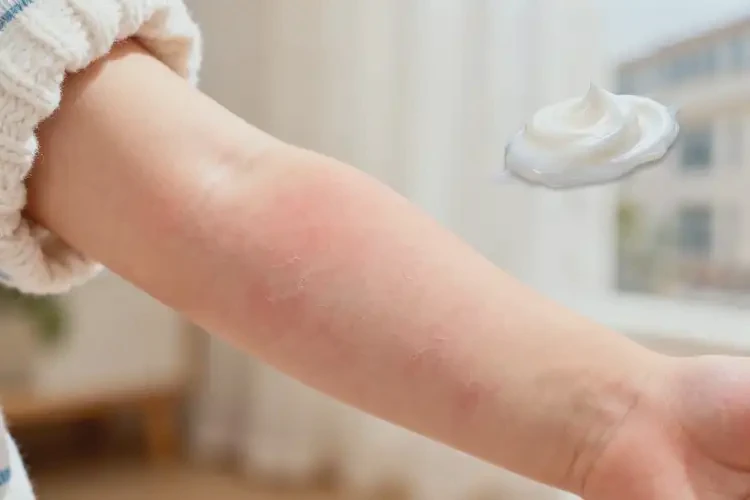 小孩手臂上出現(xiàn)濕疹能靠自己自愈嗎(圖3)