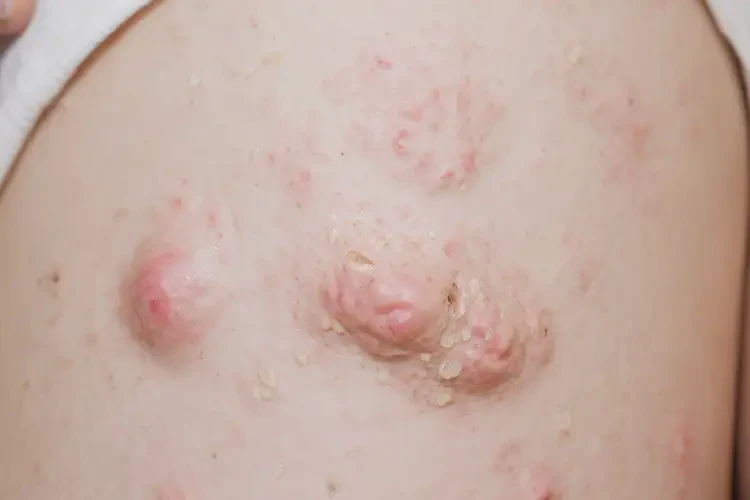 孕婦小腿經(jīng)常長(zhǎng)濕疹能徹底自愈嗎(圖4)