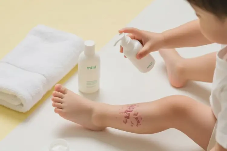 少兒大腿經(jīng)常長(zhǎng)濕疹能徹底自愈嗎(圖2)