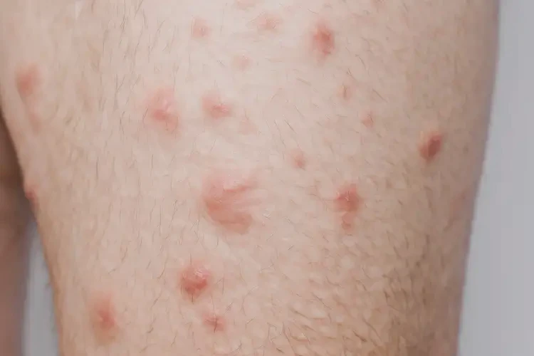 青年人大腿有濕疹不管它會自己好嗎(圖3)