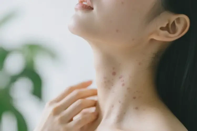 女人脖子长湿疹能够彻底治愈吗(图3)