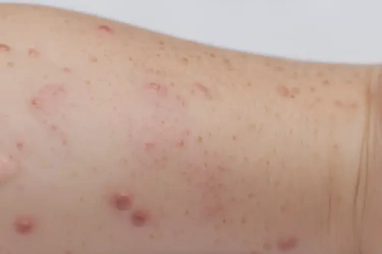 幼兒手臂上偶爾長濕疹能靠自己自愈嗎(圖4)
