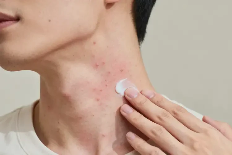 男性脖子容易起濕疹能靠自己自愈嗎(圖4)