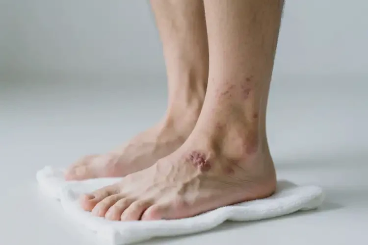 男性腳上經(jīng)常起濕疹能徹底自愈嗎(圖2)