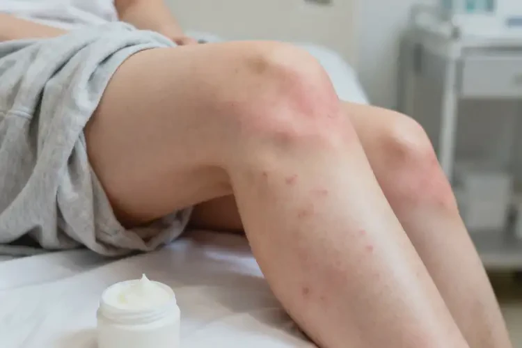 女生大腿偶爾起濕疹不管它會自己自愈嗎(圖2)