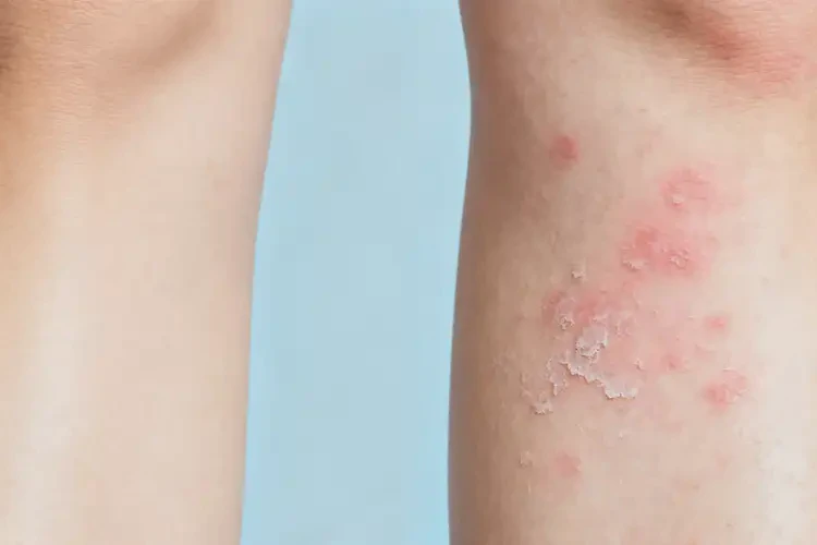 女生身上容易起濕疹可以徹底自愈嗎(圖1)