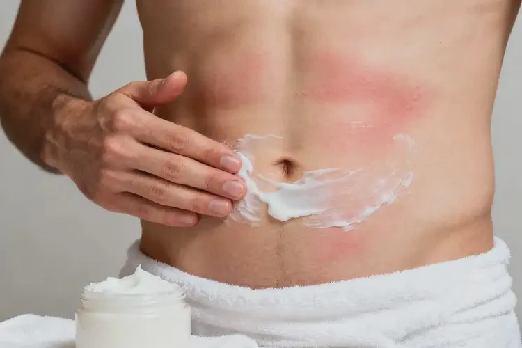 男性肚子上經(jīng)常起濕疹能徹底自愈嗎(圖2)