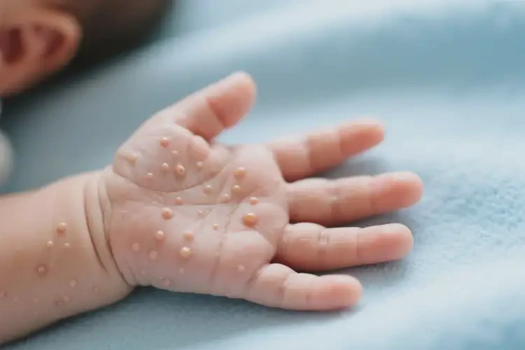 新生兒手上經(jīng)常起濕疹不管它會自己好嗎(圖3)