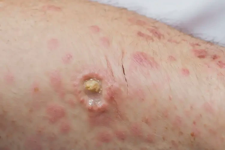 女人肚子上偶爾起濕疹不管它會(huì)自己痊愈嗎(圖3)