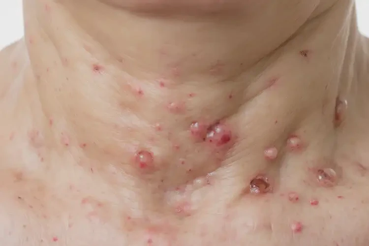 女生脖子經(jīng)常起濕疹不管它會自己痊愈嗎(圖4)