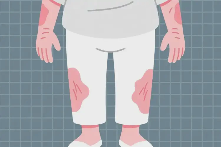 老人四肢出濕疹能靠自己自愈嗎(圖1)