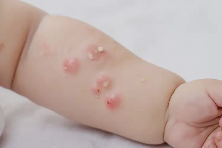 嬰幼兒手臂容易長(zhǎng)濕疹能靠自己自愈嗎(圖4)