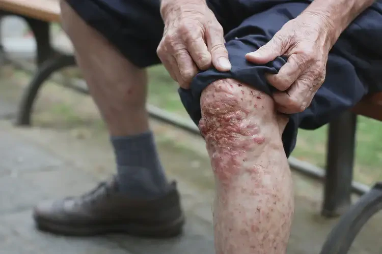 老人小腿上容易長濕疹可不可以徹底自愈(圖4)
