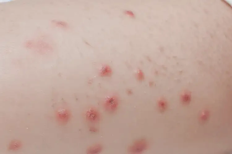 兒童小腿上出現(xiàn)濕疹不管它會自己好嗎(圖4)