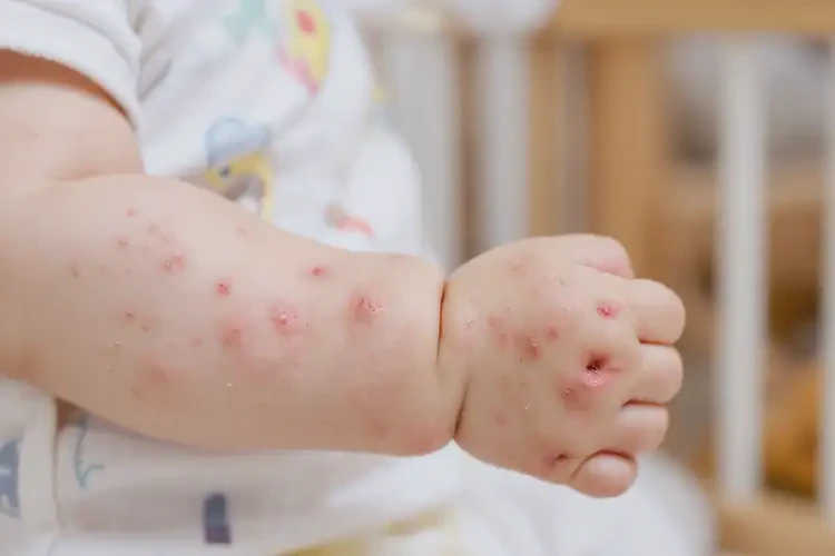 嬰兒手臂上有濕疹可不可以徹底自愈(圖4)
