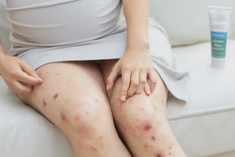 孕婦大腿上經(jīng)常長(zhǎng)濕疹可以徹底自愈嗎(圖4)