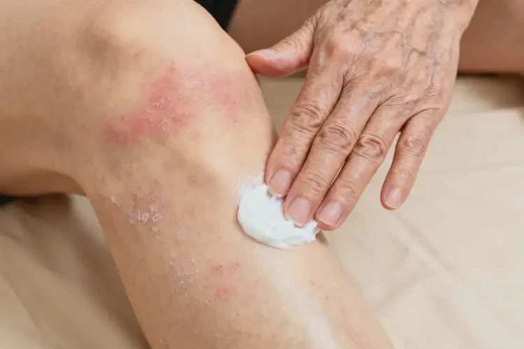 老人大腿上出現(xiàn)濕疹不管它會自己痊愈嗎(圖1)
