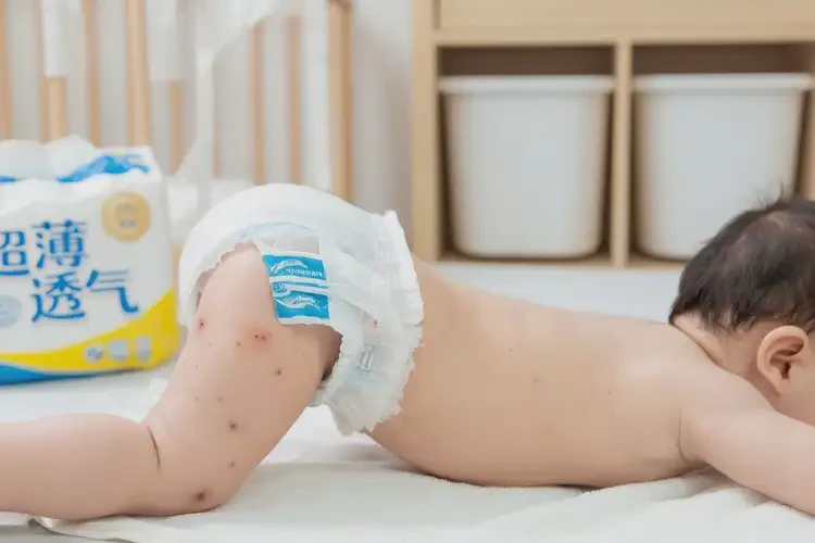孩子屁股上偶爾長濕疹不管它會自己自愈嗎(圖3)