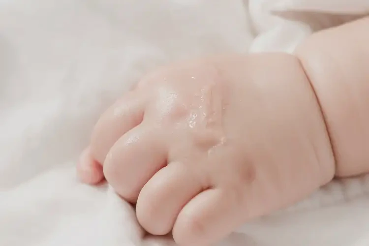 幼兒手上出現(xiàn)濕疹能靠自己自愈嗎(圖2)