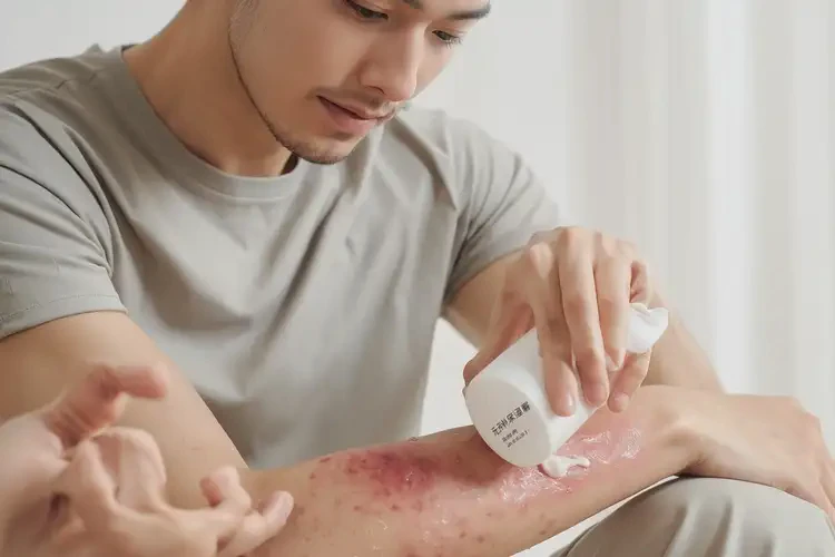 男生身上有濕疹可以徹底自愈嗎(圖2)