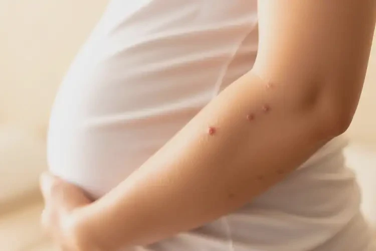 孕婦手臂容易起濕疹可不可以徹底自愈(圖1)