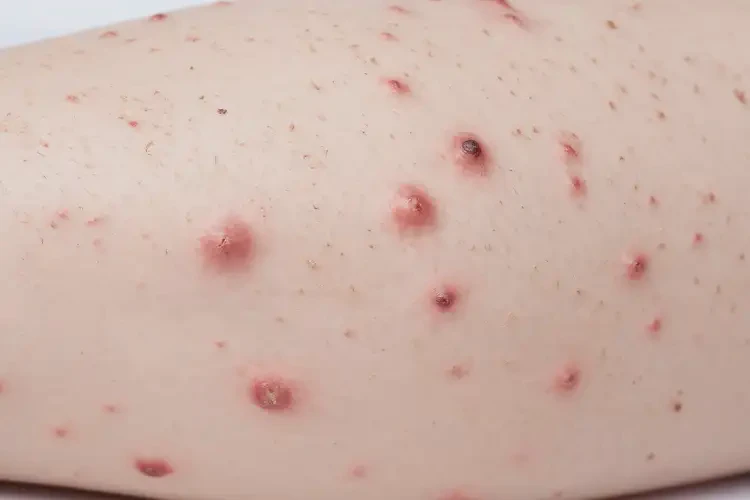 青少年小腿上经常起湿疹能彻底自愈吗(图3)