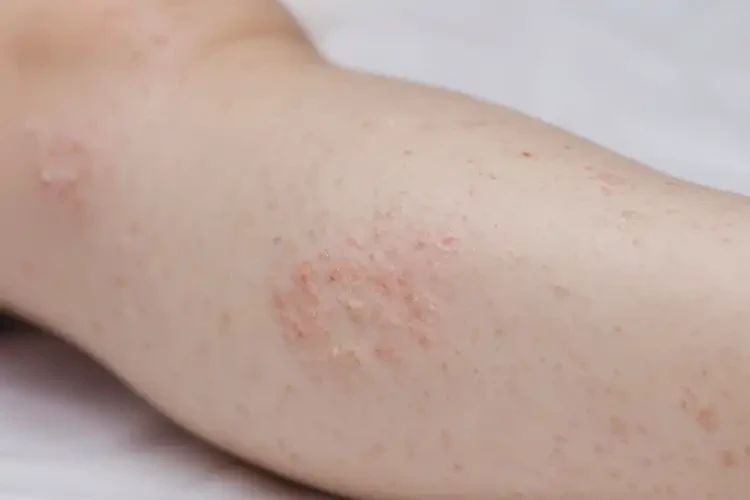 小孩腳上起濕疹不管它會自己好嗎(圖4)