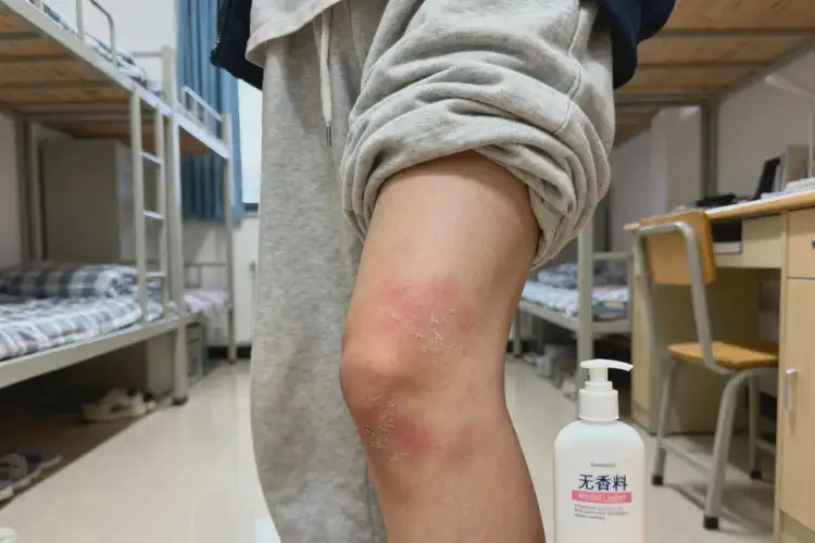 大学生大腿上有湿疹不管它会自己自愈吗(图2)