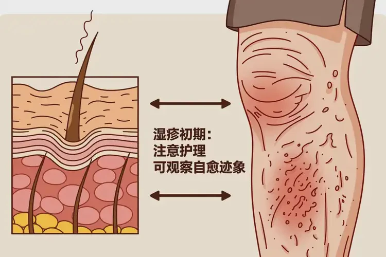 老年人大腿出濕疹不管它會自己自愈嗎(圖2)