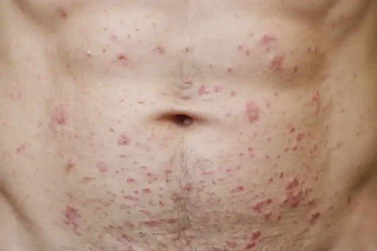 男性肚子上偶爾長(zhǎng)濕疹能靠自己自愈嗎(圖4)