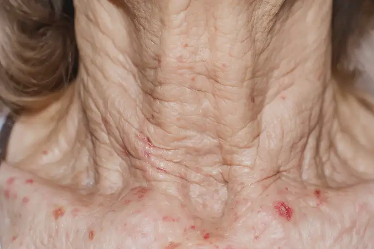 老年人脖子上偶爾長濕疹可不可以徹底自愈(圖4)