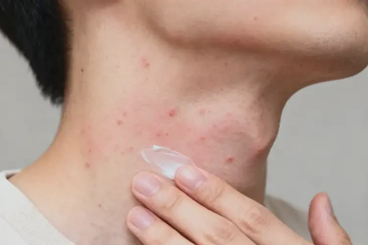 男性脖子容易起濕疹能靠自己自愈嗎(圖3)