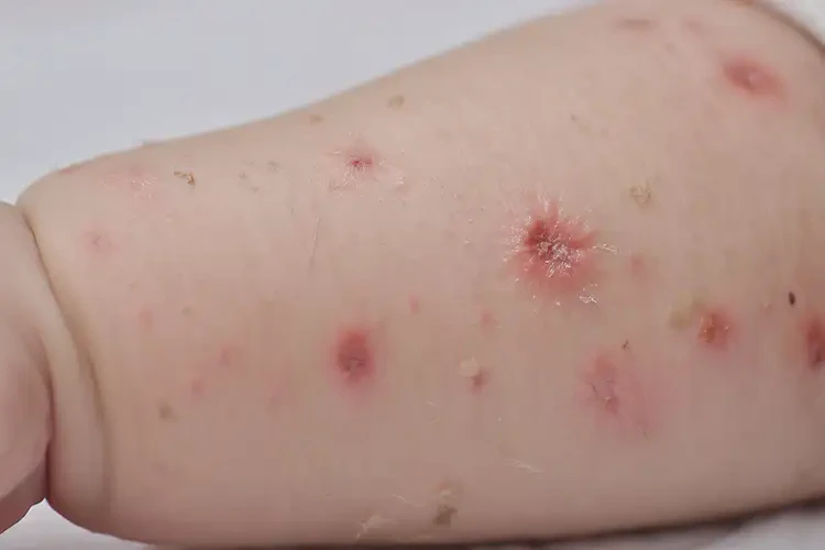 孩子身上經(jīng)常長濕疹可以徹底自愈嗎(圖4)