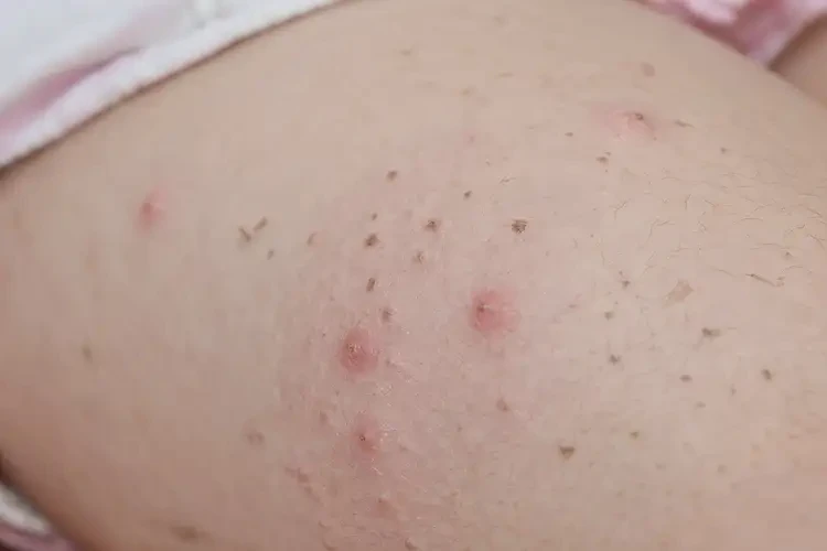 孩子大腿上偶爾起濕疹能靠自己自愈嗎(圖4)