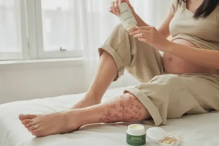 孕婦小腿經(jīng)常長(zhǎng)濕疹能徹底自愈嗎(圖3)